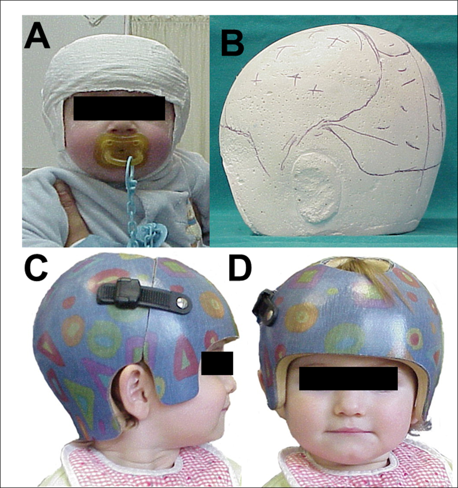 caschi e ortesi cranio per plagiocefalia posizionale